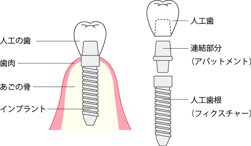 インプラント治療